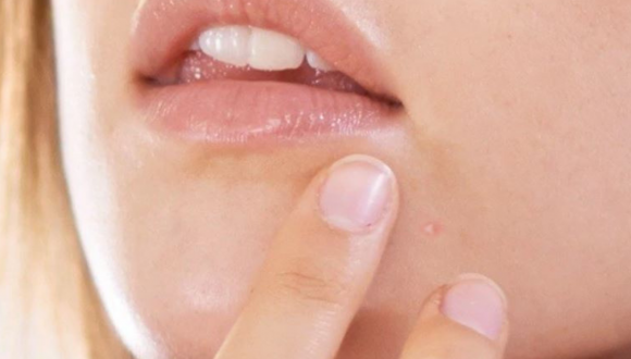 Acne: wat helpt écht?