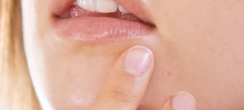 Acne: wat helpt écht?